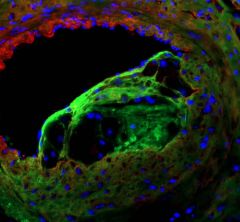 immunofluorescent staining of the coronary lesion 